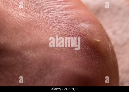 Close-up of a man's foot with a callus and dry skin Stock Photo