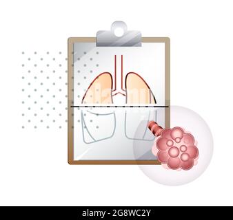 Covid-19 Impact on Human Lungs - PULMONARY EDEMA - Illustration as EPS 10 File Stock Vector