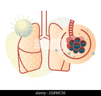 Covid-19 Impact on Human Lungs - PULMONARY EDEMA - Illustration as EPS 10 File Stock Vector