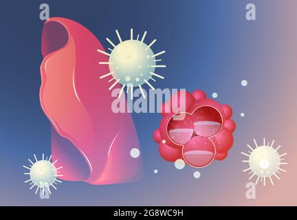 Covid-19 Impact on Human Lungs - PULMONARY EDEMA - Illustration as EPS 10 File Stock Vector