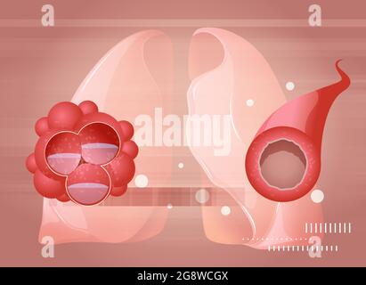 Covid-19 Impact on Human Lungs - PULMONARY EDEMA and Inflamed Airway  - Illustration as EPS 10 File Stock Vector