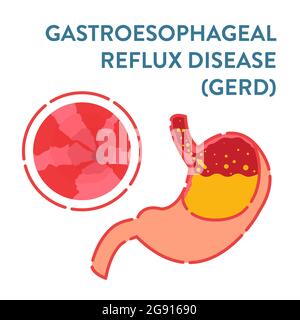 Gastroesophageal reflux disease, illustration Stock Photo