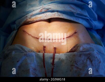 Close up of woman belly with suture line after tummy tuck surgery. Female patient with surgical stitch on abdomen lying on operating table after abdominal plastic surgery. Concept of abdominoplasty. Stock Photo