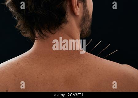 patient's back and shoulder pain treatment with acupuncture procedure. Close-up, back view, over black background Stock Photo