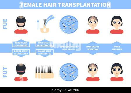 Hair transplantation in women, illustration Stock Photo