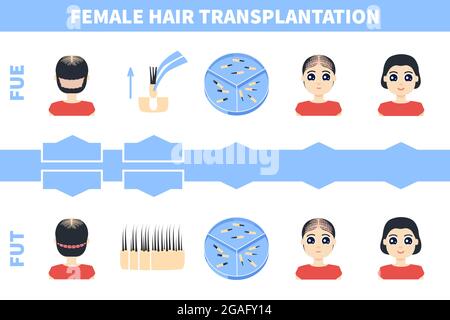 Hair transplantation in women, illustration Stock Photo