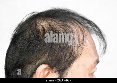 Thinning or sparse hair, male pattern hair loss in Southeast Asian, Chinese elder man. Isolated on white. Stock Photo