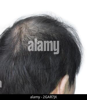 Thinning or sparse hair, male pattern hair loss in Southeast Asian, Chinese elder man. Isolated on white. Stock Photo