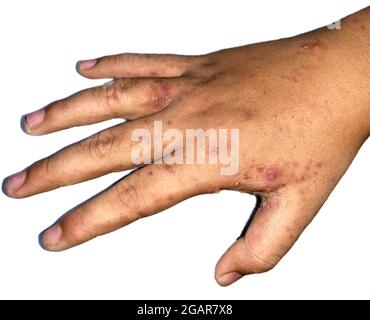 SCABIES LESIONS BETWEEN FINGERS Stock Photo - Alamy