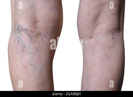 Southeast Asian, Myanmar old woman’s legs. Skin creases, loosen and thin skin and veins show aging. Isolated on white background. Stock Photo