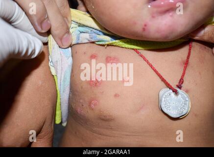 Multiple impetigoes or numerous Staphylococcal / Streptococcal skin infection in  chest of Southeast Asian Burmese child in clinic of Myanmar Stock Photo