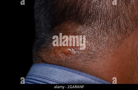 Seborrheic dermatitis at the nape of Southeast Asian, Myanmar adult male patient. Right lateral view. Stock Photo