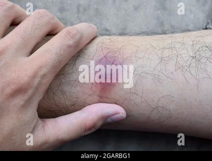 Bruise in right leg of Asian Burmese male patient. Closeup view. Stock Photo