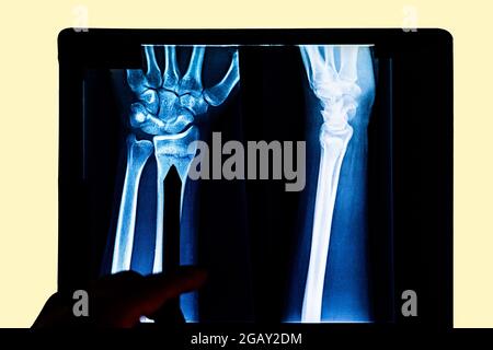 radiography examining x-ray film of patient's arm pointing to radius fracture. X-rayed human hand. X-ray of hand bones. Medical technology radiography Stock Photo