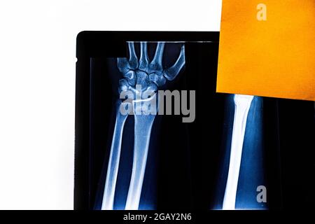 Examining x-ray film of patient's arm pointing to radius fracture. Radiography. X-rayed human hand. X-ray of hand bones. Medical technology radiograph Stock Photo