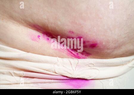 Surgical stitches,suture wound at abdomen. A wound on the abdomen of a person. Skin damage treated with antiseptic and medicinal ointment. Stock Photo