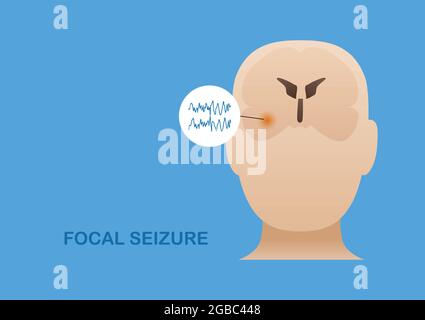 Temporal lobe epilepsy. Vector illustration of human focal seizure. Abnormal brain waves arising from the side of brain