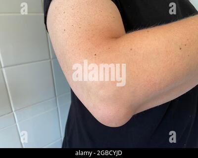 olecranon bursitis is sometimes called “Popeye’s elbow.” Bursitis is a swelling of the bursitis sac here on elbow also known as tennis elbow Stock Photo