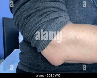 olecranon bursitis is sometimes called “Popeye’s elbow.” Bursitis is a swelling of the bursitis sac here on elbow also known as tennis elbow Stock Photo