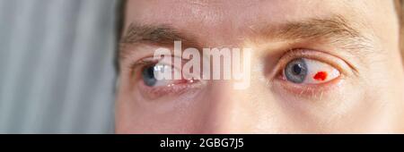 Man damaged eye ball. Conjunctivitis blood. Allergy ophtalmology test. Stock Photo