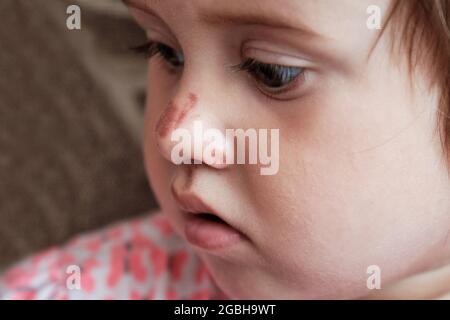 Portrait of a sad little girl with a scratched nose, close-up, selective focus. Child safety concept, injuries from falling down Stock Photo