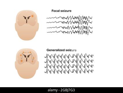 Vector illustration of seizure types demonstrating by onset and brain waves. Focal seizure and generalized seizure. Electroencephalograhy or EEG of se