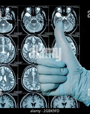 MRI Scan image of a human brain showing all main multiple sclerosis hand in bliue glove thumbs up Stock Photo