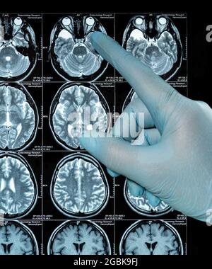 MRI Scan image of a human brain showing all main multiple sclerosis hand in bliue glove points Stock Photo