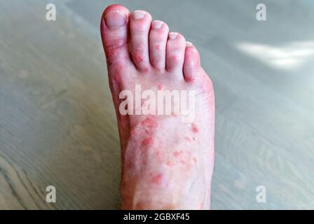 Legs with many red spot and scar from insect bites. Mosquitos allergy. Sand  fly bites Stock Photo - Alamy