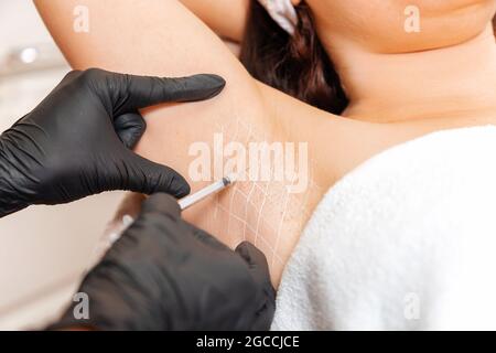 Cosmetologist in black latex gloves makes injection of botulinum toxin on the woman's axillary hollows against hyperhidrosis. Armpit with white drawn Stock Photo