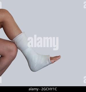 Broken leg with the cast rests on the knee of the other leg. Stock Photo