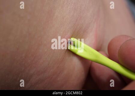 Removal of sucking tick, Ixodes ricinus, from human skin with yellow tweezers Stock Photo