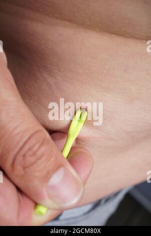 Removal of sucking tick, Ixodes ricinus, from human skin with yellow tweezers Stock Photo
