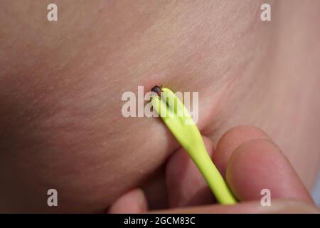 Removal of sucking tick, Ixodes ricinus, from human skin with yellow tweezers Stock Photo