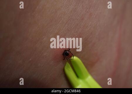 Removal of sucking tick, Ixodes ricinus, from human skin with yellow tweezers Stock Photo
