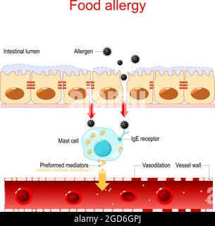 Food allergy and leaky gut. abnormal immune response to food. Vector illustration Stock Vector
