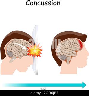 Concussion. Human's head. brain after head trauma. Vector illustration Stock Vector