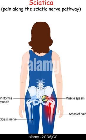 Sciatica. Areas of pain. Sciatic nerve from lower back and hip region ...