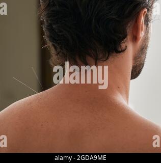 Treatment of back pain and shoulders tightness with acupuncture needles for a male patient. Alternative medicine, reflexology Stock Photo