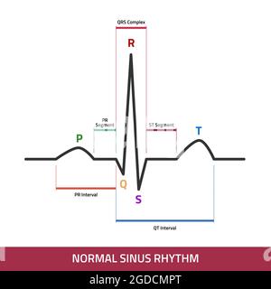 EKG showing normal heartbeat wave. ECG of Normal Sinus Rhythm infographic diagram. Stock Vector