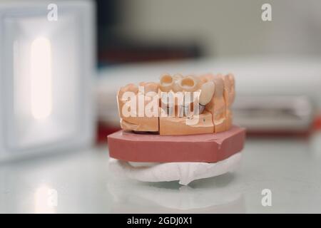 Dental layout of the human jaw with teeth and implants Stock Photo - Alamy