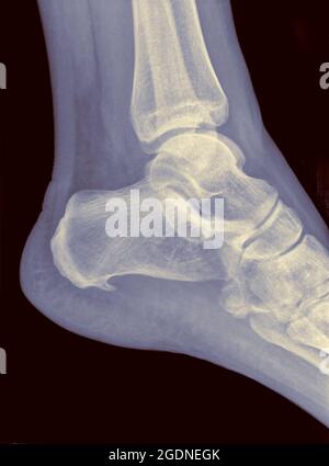 X-ray of a foot showing Plantar fasciitis (also known as Plantar ...