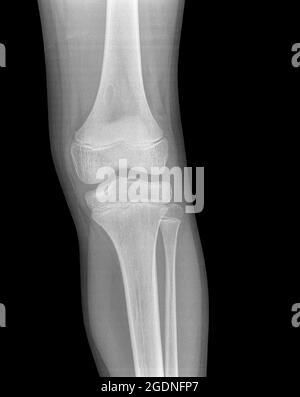 13 year old male with a contusion on the left knee. front view. no fracture Stock Photo