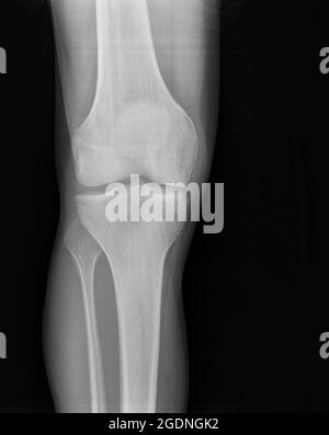 Synovitis of the right knee of a 27 year old male front view Stock Photo