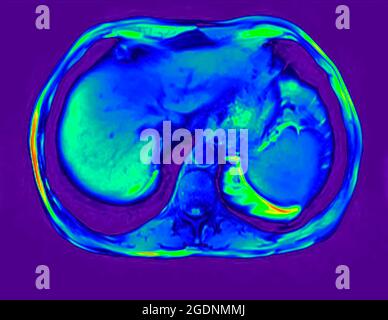 Cross section Abdomen MRI scan of a 60 year old male patient. This patient suffers from a kidney stone Stock Photo