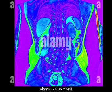 Frontal Abdomen MRI scan of a 60 year old male patient. This patient suffers from a kidney stone Stock Photo