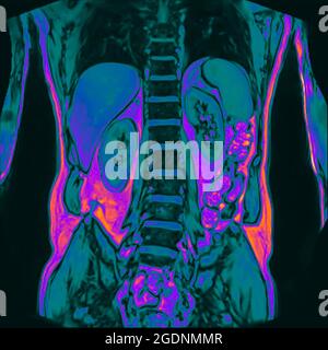 Frontal Abdomen MRI scan of a 60 year old male patient. This patient suffers from a kidney stone Stock Photo