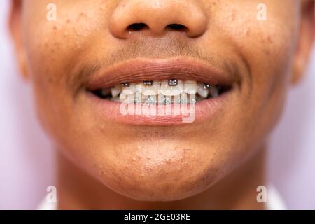 Young teenager shot up closely with braces on Stock Photo