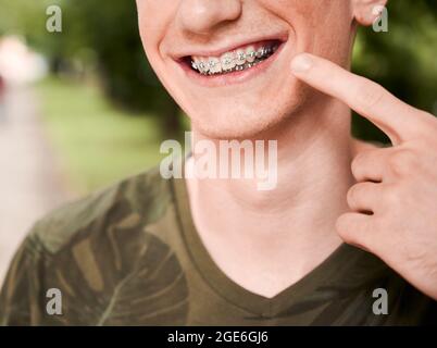Close-up, cropped snapshot of man's smile wearing dental braces, posing outdoors, pointing at his mouth. Horizontal image. Macro photography. Concept Stock Photo