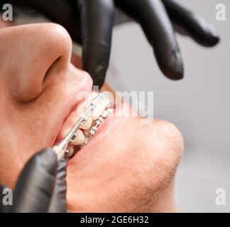 Close up of orthodontist hands in sterile gloves putting elastic rubber band on patient brackets in dental clinic. Concept of stomatology, dentistry and orthodontics. Stock Photo